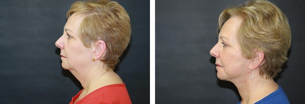 Before and After Image: Facelift - left-side