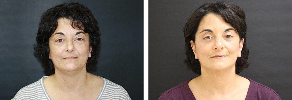 Before and After Image: Facelift - front
