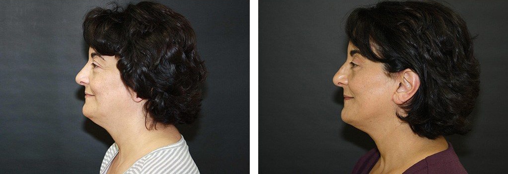 Before and After Image: Facelift - left-side