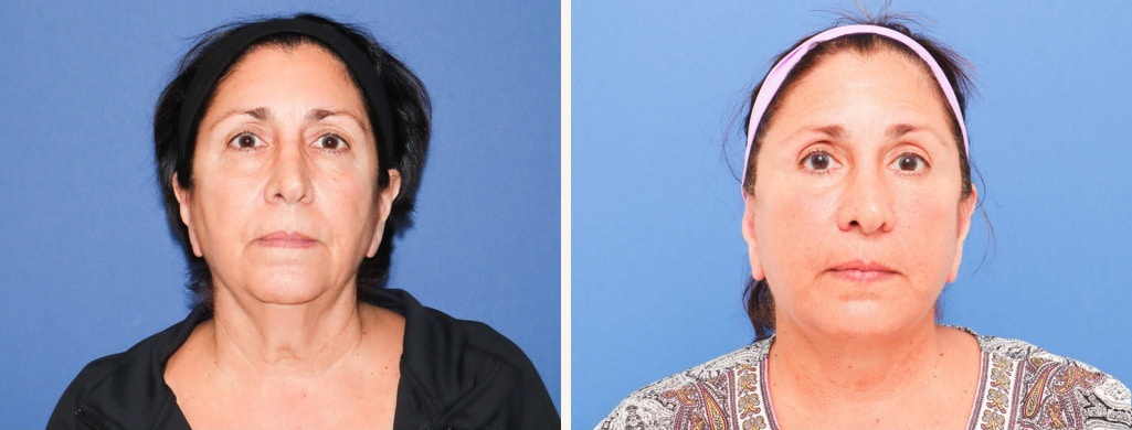 Before and After Image: Facelift - front