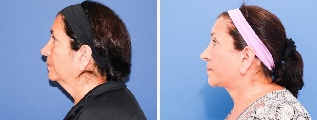 Before and After Image: Facelift - left-side