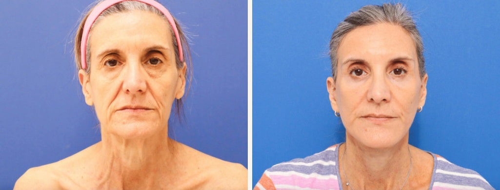 Before and After Image: Facelift - front