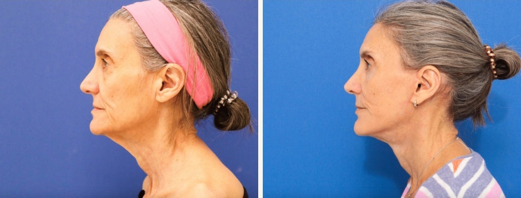 Before and After Image: Facelift - left-side