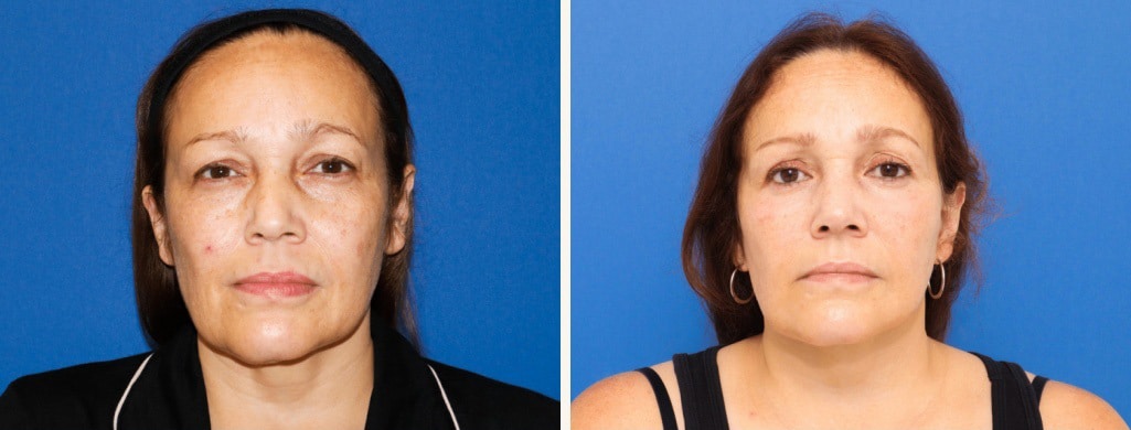 Before and After Image: Facelift - front