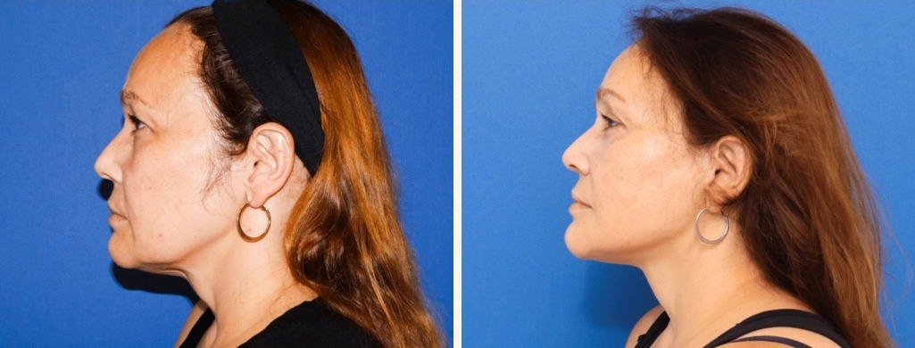 Before and After Image: Facelift - left-side