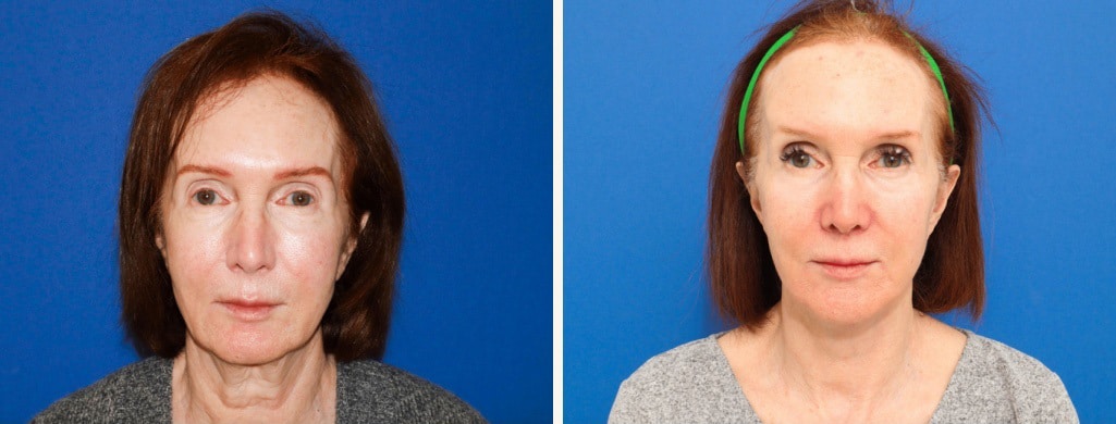 Before and After Image: Facelift - front