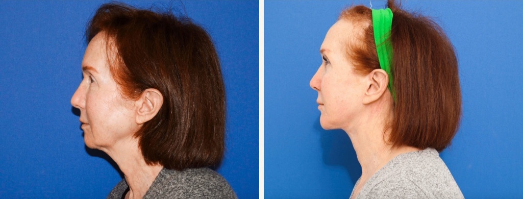 Before and After Image: Facelift - left-side