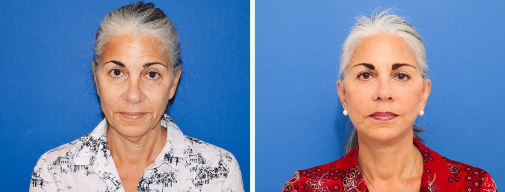 Before and After Image: Facelift - front