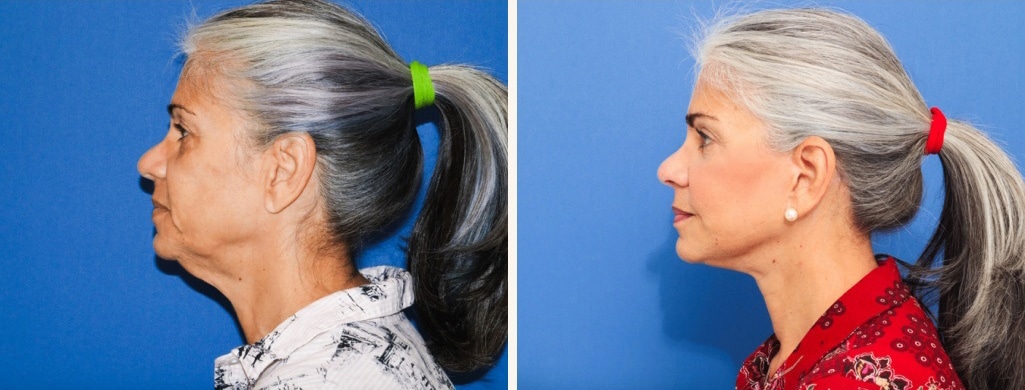 Before and After Image: Facelift - left-side