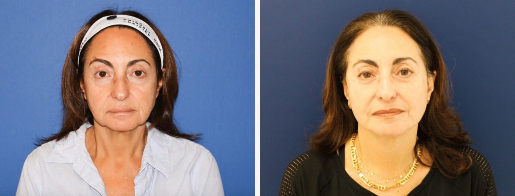 Before and After Image: Facelift - front