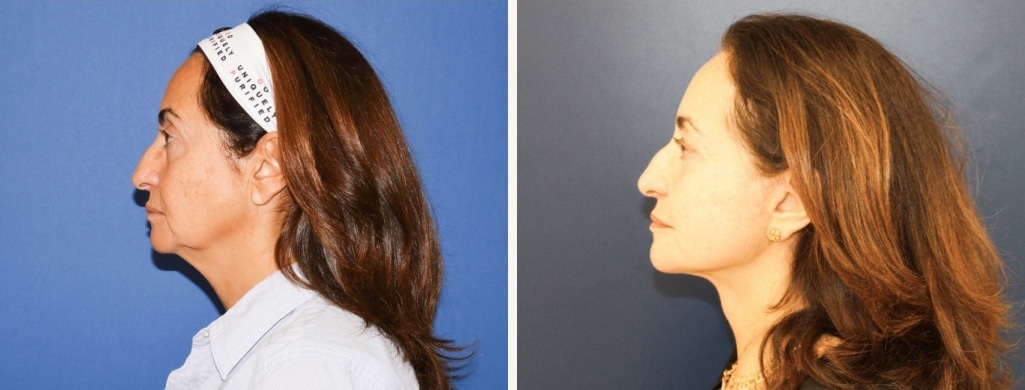 Before and After Image: Facelift - left-side