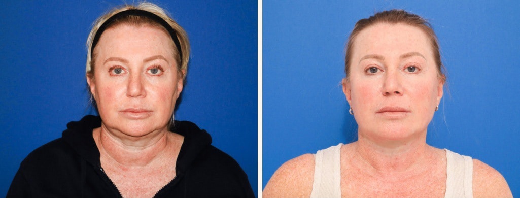 Before and After Image: Facelift - front