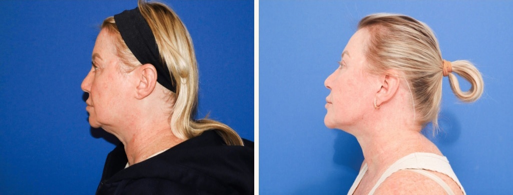 Before and After Image: Facelift - left-side