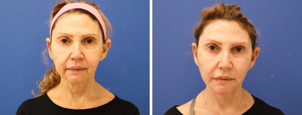 Before and After Image: Facelift - front
