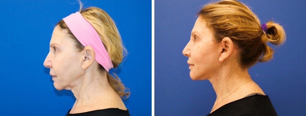 Before and After Image: Facelift - left-side