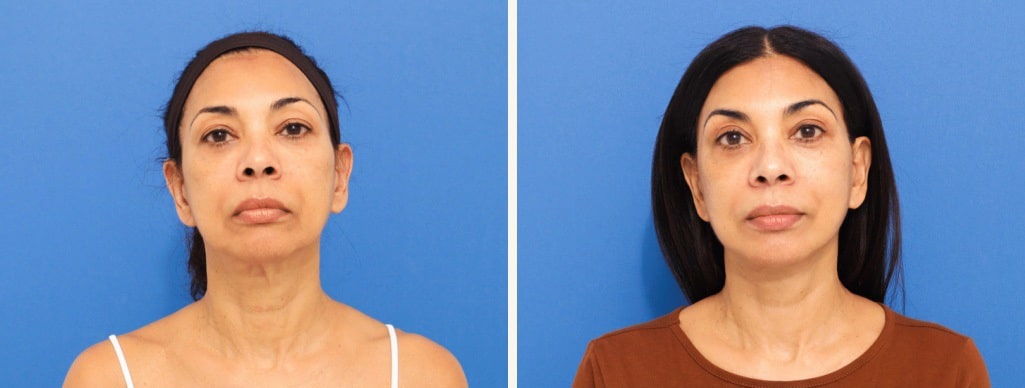 Before and After Image: Facelift - front
