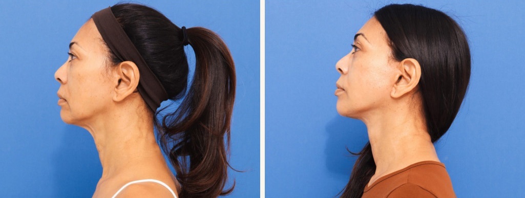 Before and After Image: Facelift - left-side