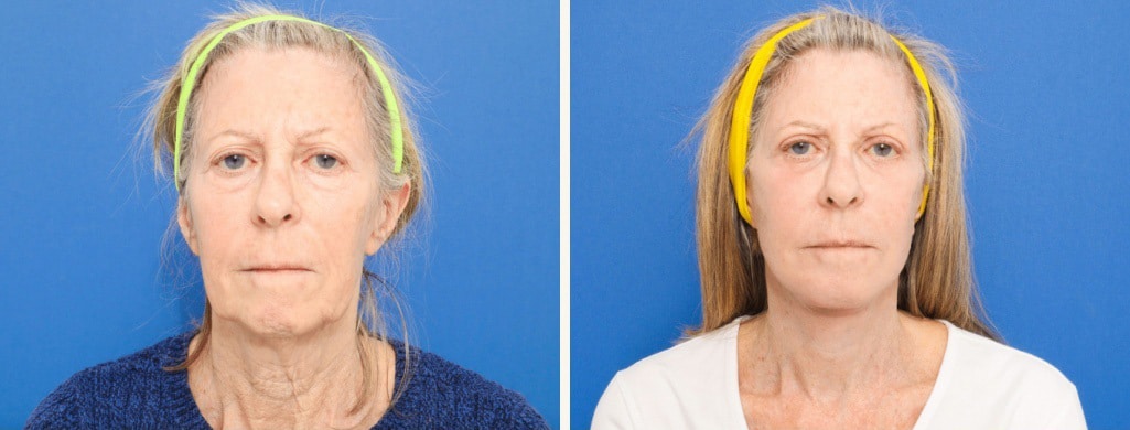 Before and After Image: Facelift - front