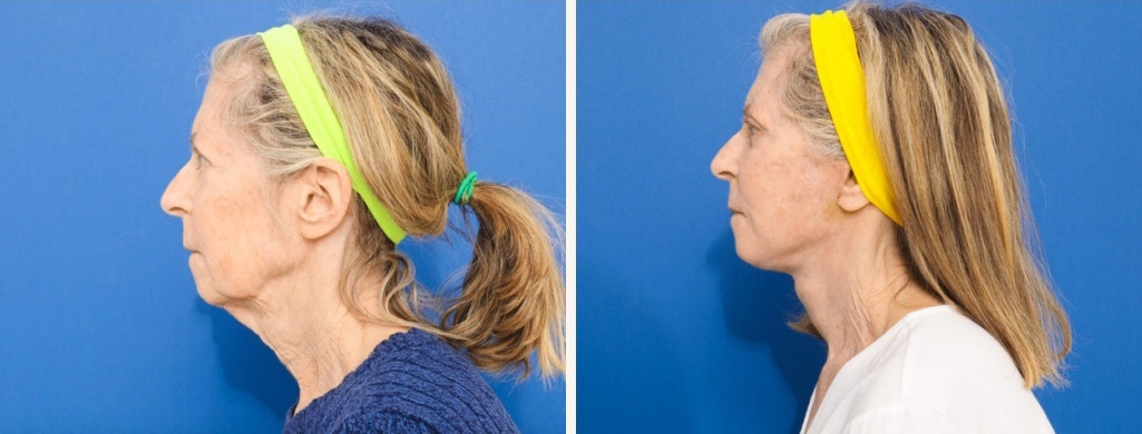 Before and After Image: Facelift - left-side