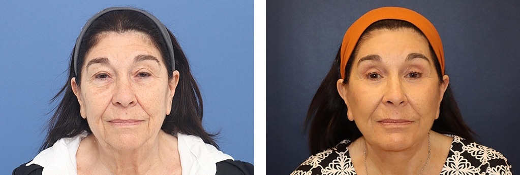 Before and After Image: Facelift - front