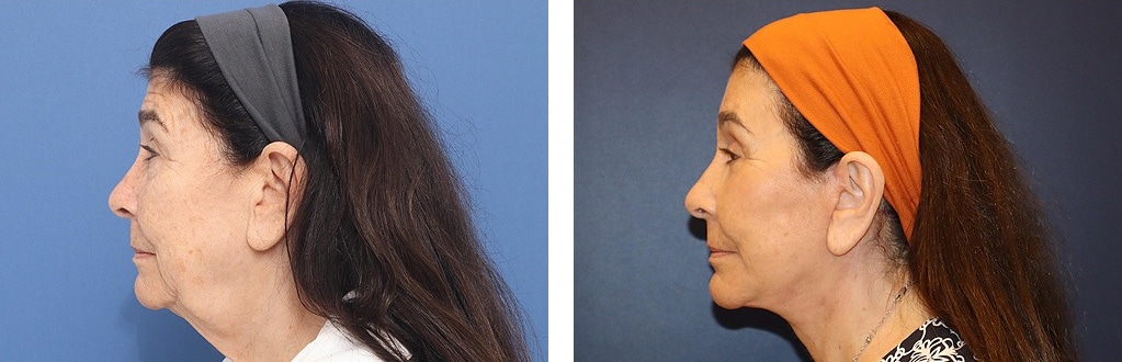 Before and After Image: Facelift - left-side