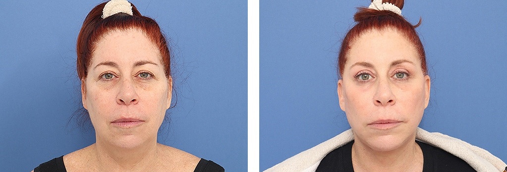 Before and After Image: Facelift - front