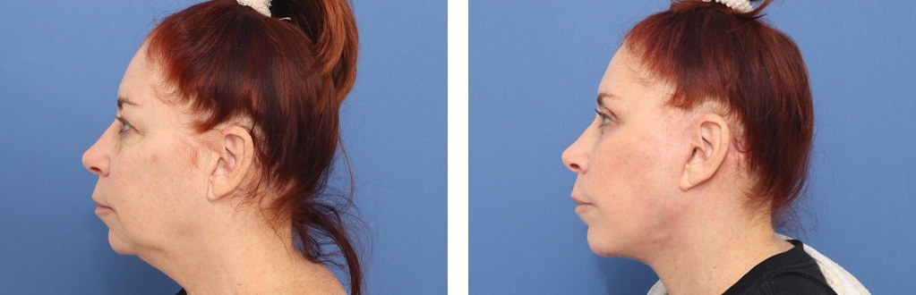 Before and After Image: Facelift - left-side