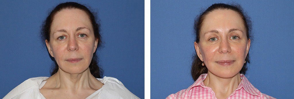Before and After Image: Facelift - front