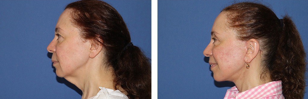 Before and After Image: Facelift - left-side