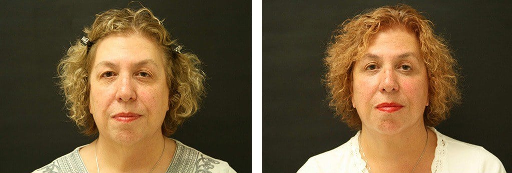 Before and After Image: Facelift - front