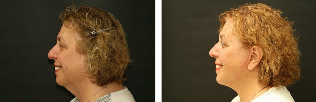 Before and After Image: Facelift - left-side