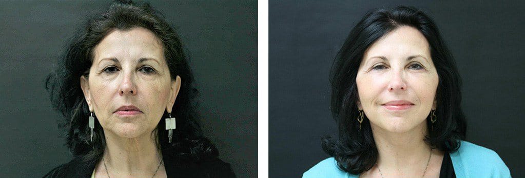 Before and After Image: Facelift - front