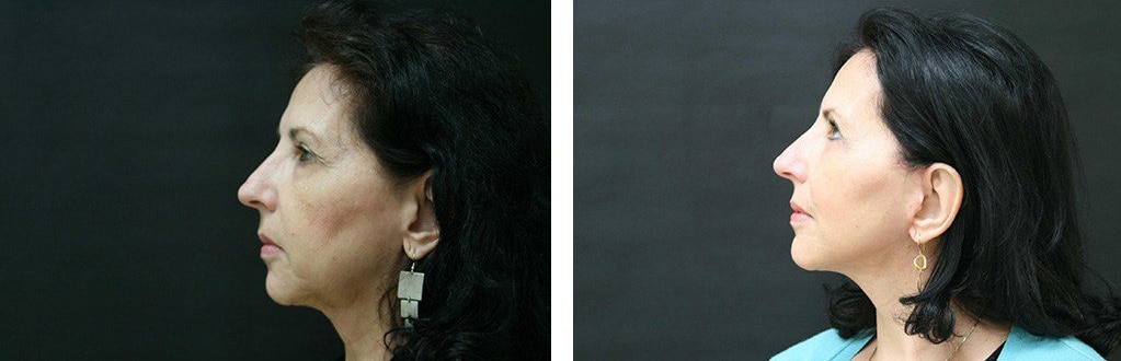 Before and After Image: Facelift - left-side