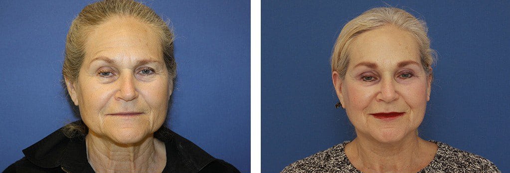 Before and After Image: Facelift - front