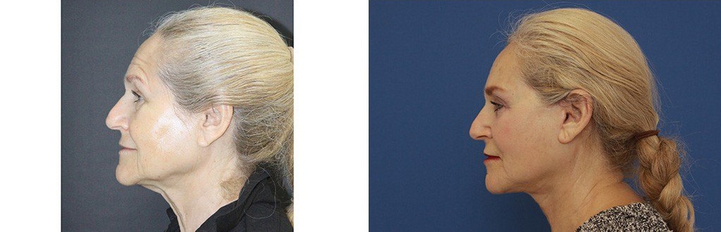 Before and After Image: Facelift - left-side