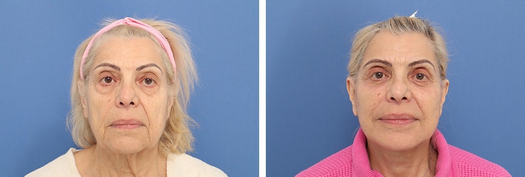 Before and After Image: Facelift - front