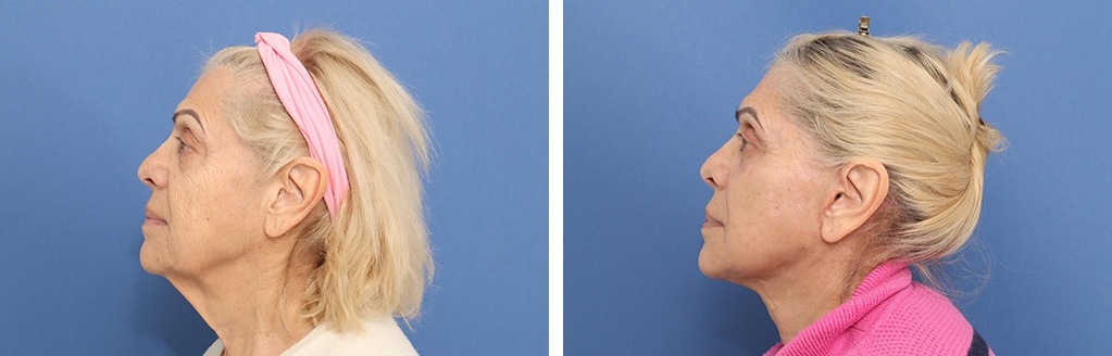Before and After Image: Facelift - left-side