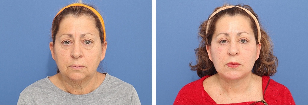 Before and After Image: Facelift - front