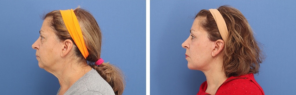 Before and After Image: Facelift - left-side