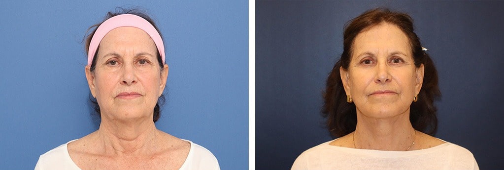 Before and After Image: Facelift - front