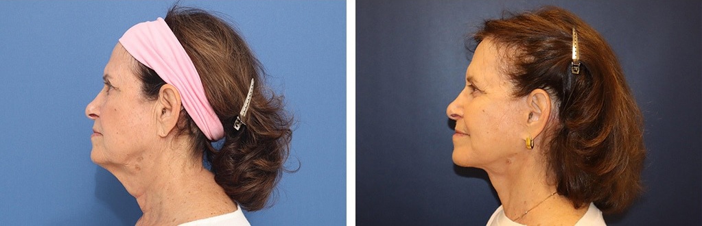 Before and After Image: Facelift - left-side