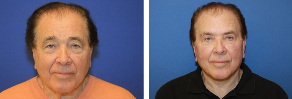 Before and After Image: Facelift - front