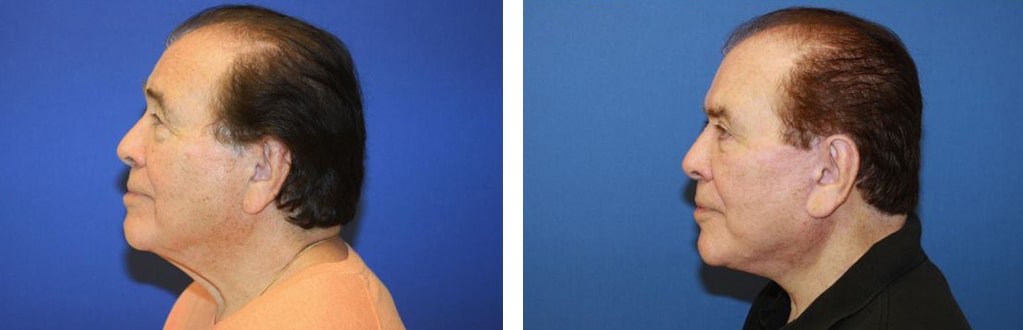 Before and After Image: Facelift - left-side