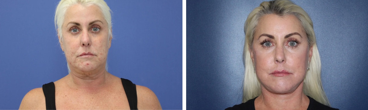 Before and After Image: Facelift - front