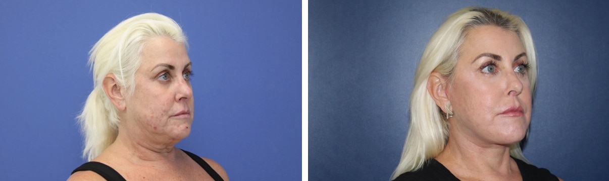 Before and After Image: Facelift - right-front-oblique