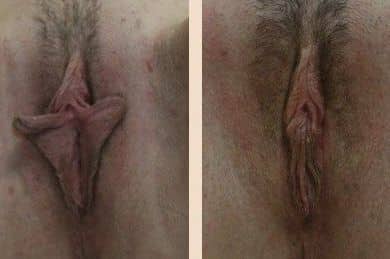Before and After Image: Labiaplasty - front