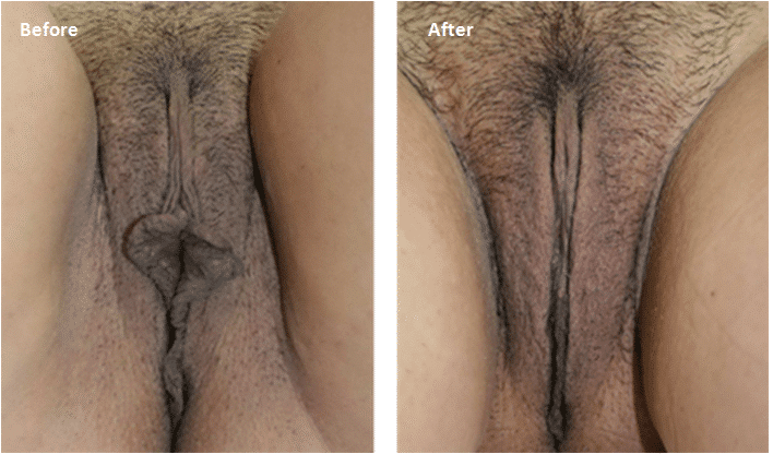 Before and After Image: Labiaplasty - front
