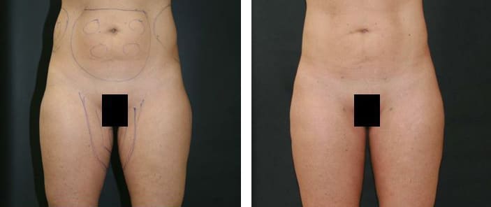 Before and After Image: Liposuction - front