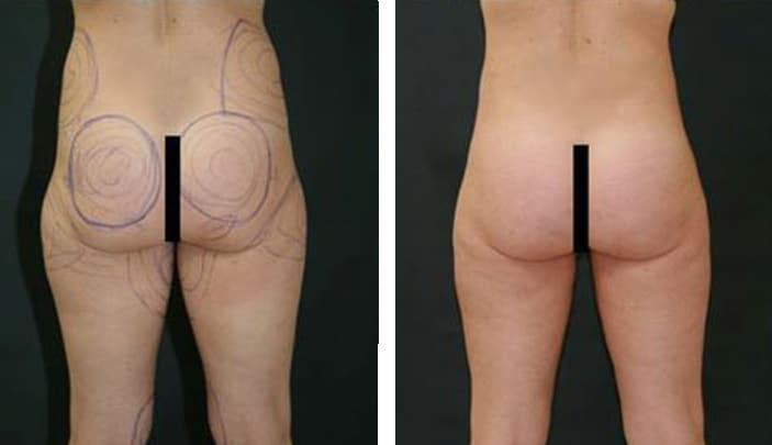 Before and After Image: Liposuction - back