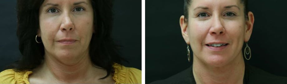 Before and After Image: Liposuction - front